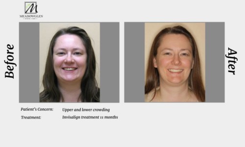 Invisalign at Meadowglen Dental Care in Whitby, ON.