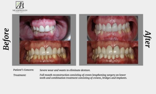 Crowns and Bridges at Meadowglen Dental Care in Whitby, ON.