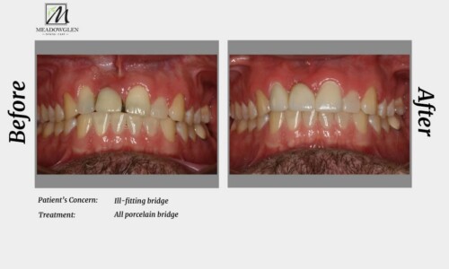 Crowns and Bridges at Meadowglen Dental Care in Whitby, ON.
