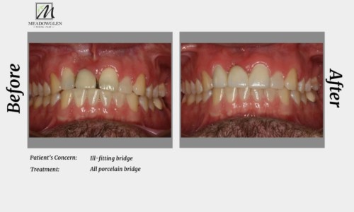 Crowns and Bridges at Meadowglen Dental Care in Whitby, ON.