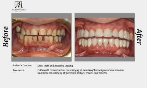 Crowns and Bridges at Meadowglen Dental Care in Whitby, ON.