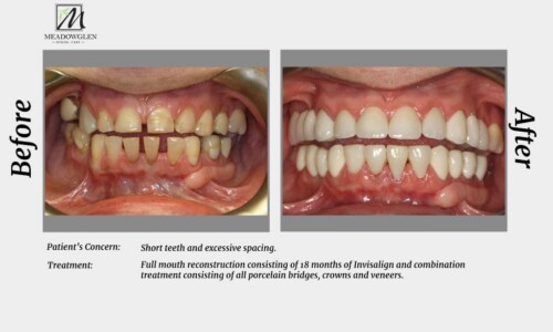 Crowns and Bridges at Meadowglen Dental Care in Whitby, ON.