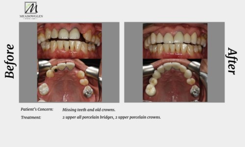 Crowns and Bridges at Meadowglen Dental Care in Whitby, ON.