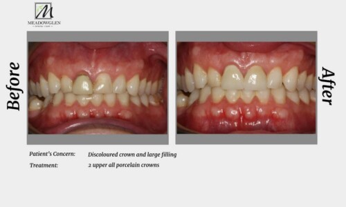 Crowns and Bridges at Meadowglen Dental Care in Whitby, ON.