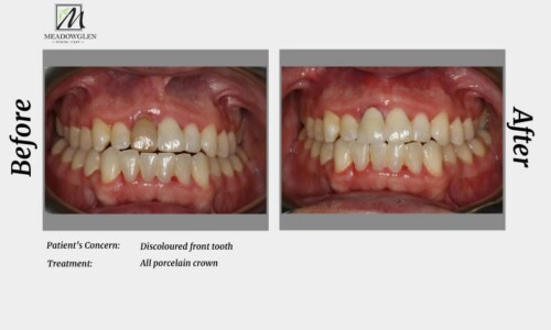 Crowns and Bridges at Meadowglen Dental Care in Whitby, ON.