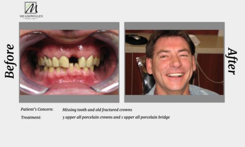 Crowns and Bridges at Meadowglen Dental Care in Whitby, ON.