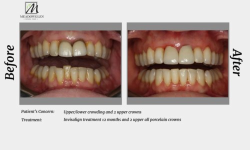 Crowns and Bridges at Meadowglen Dental Care in Whitby, ON.