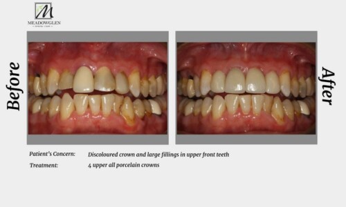 Crowns and Bridges at Meadowglen Dental Care in Whitby, ON.