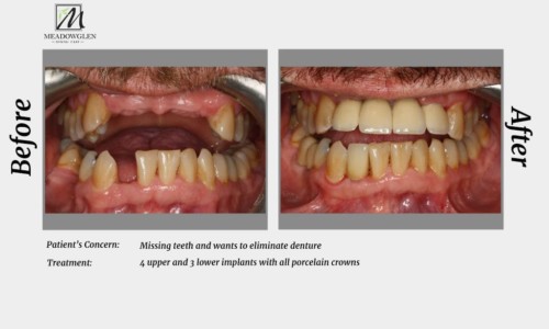 Crowns and Bridges at Meadowglen Dental Care in Whitby, ON.