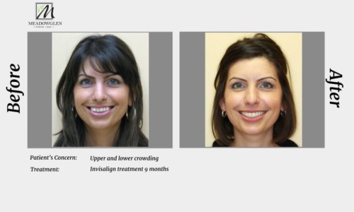 Invisalign at Meadowglen Dental Care in Whitby, ON.