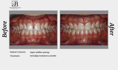 Invisalign at Meadowglen Dental Care in Whitby, ON.