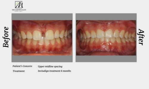 Invisalign at Meadowglen Dental Care in Whitby, ON.