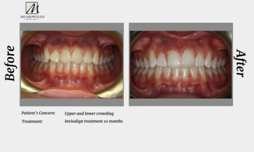 Invisalign at Meadowglen Dental Care in Whitby, ON.