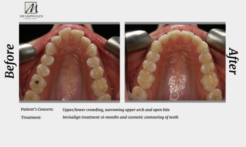 Invisalign at Meadowglen Dental Care in Whitby, ON.