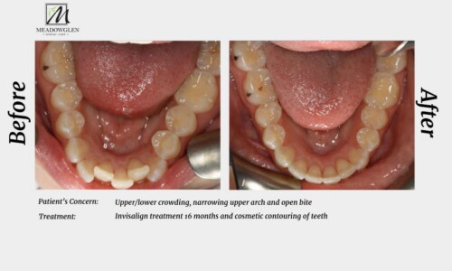 Invisalign at Meadowglen Dental Care in Whitby, ON.