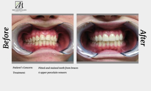 Veneers at Meadowglen Dental Care in Whitby, ON.