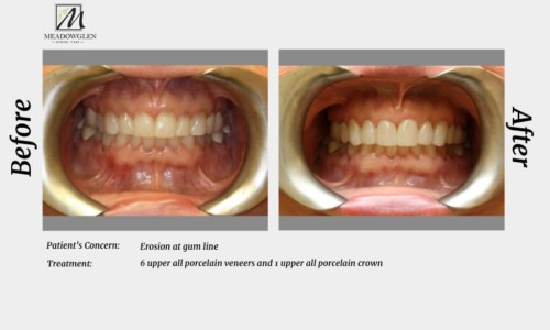 Veneers at Meadowglen Dental Care in Whitby, ON.