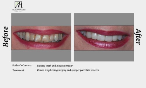 Veneers at Meadowglen Dental Care in Whitby, ON.