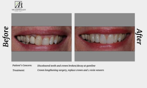 Veneers at Meadowglen Dental Care in Whitby, ON.